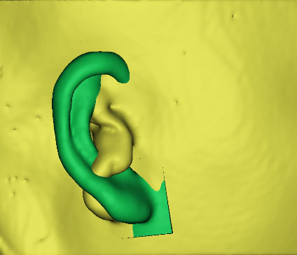 小耳畸形怎么辦？這有一份三維數(shù)字化治療方案請(qǐng)簽收！